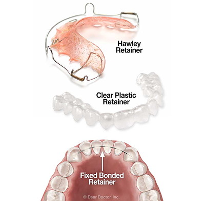 Retainers & Retention Care | Keep Your Smile Straight